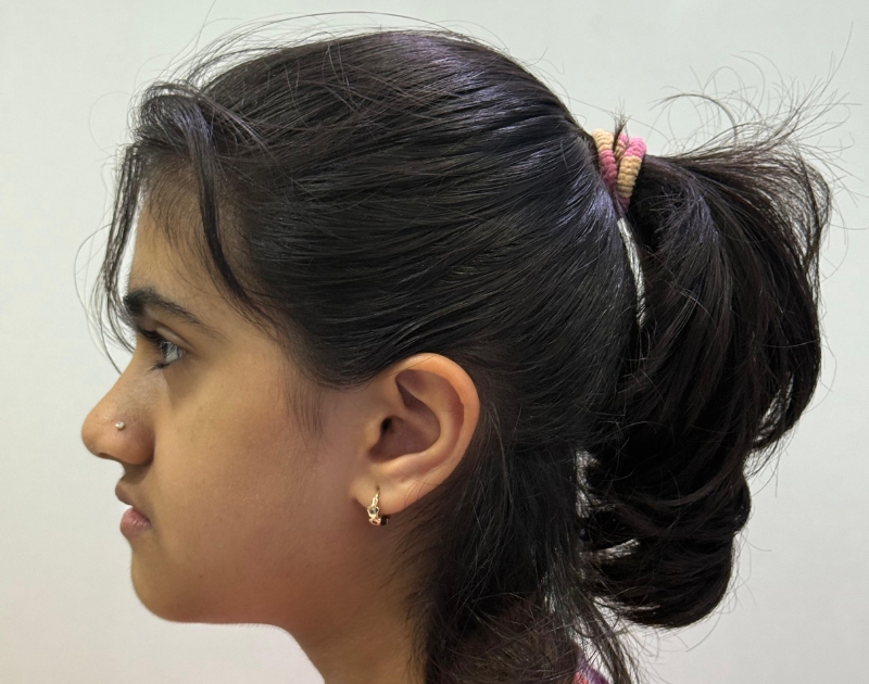 Kashvi After - Myofunctional Orthodontics