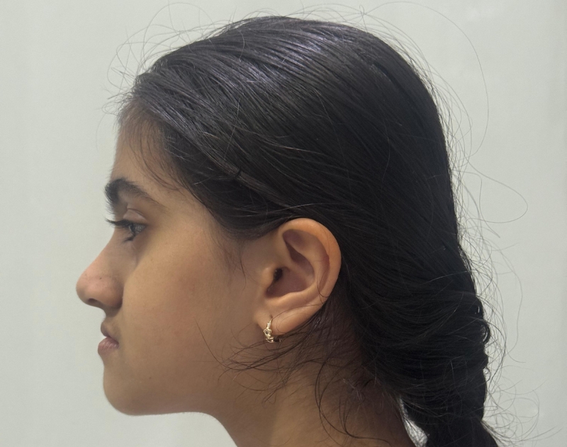 Kashvi Before - Myofunctional Orthodontics