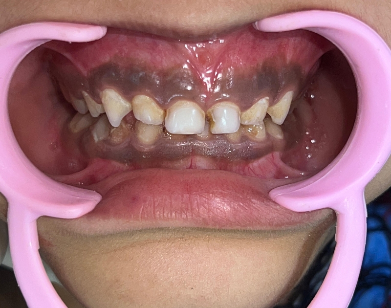 Pediatric transformation - After 01